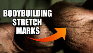 Bodybuilding Stretch Marks: Can They Be Eliminated?